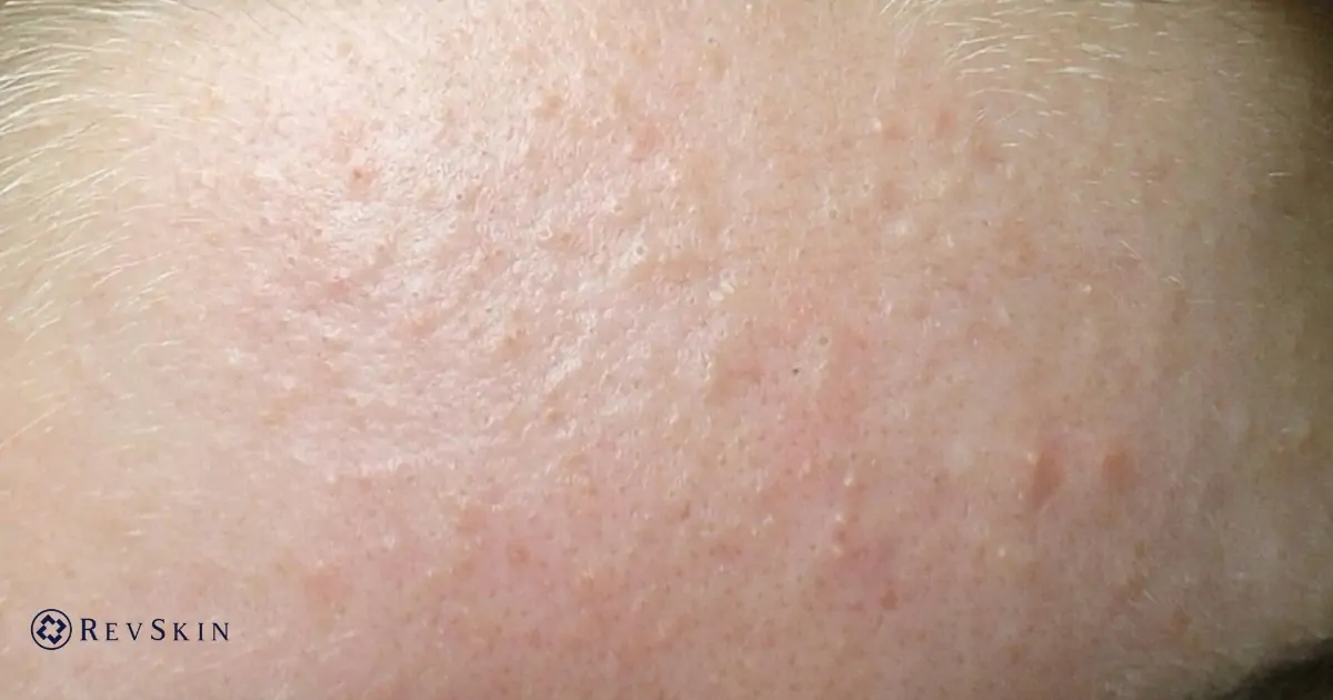 Các loại mụn thường gặp và cách nhận biết chính xác từng loại Mụn ẩn dưới da