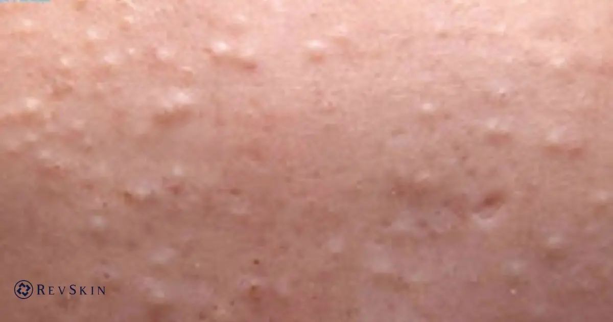 Các loại mụn thường gặp và cách nhận biết chính xác từng loại Mụn đầu trắng