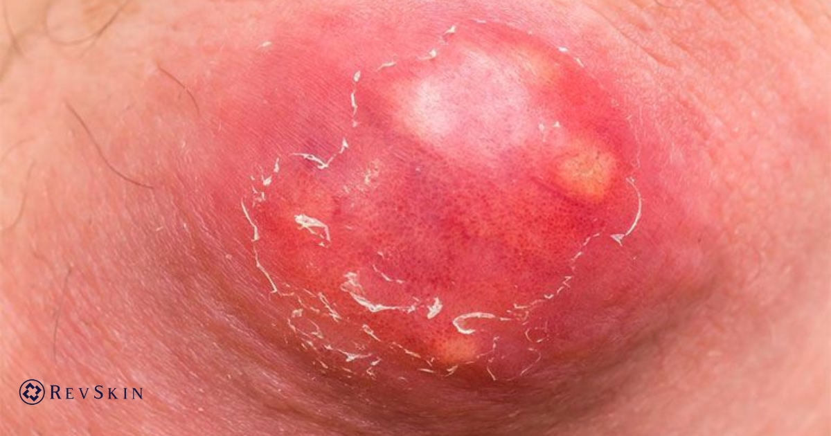 Bị mụn nhọt: 7 sự thật quan trọng và cách điều trị hiệu quả nhất hiện nay Mụn nhọt là gì