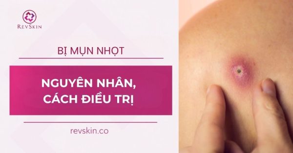 mụn nhọt nguyên nhân và cách điều trị