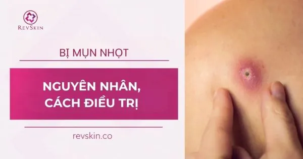 mụn nhọt nguyên nhân cách điều trị