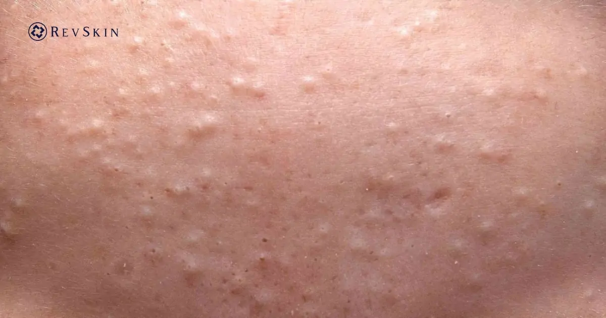 Các loại mụn thường gặp và cách nhận biết chính xác từng loại Mụn nội tiết