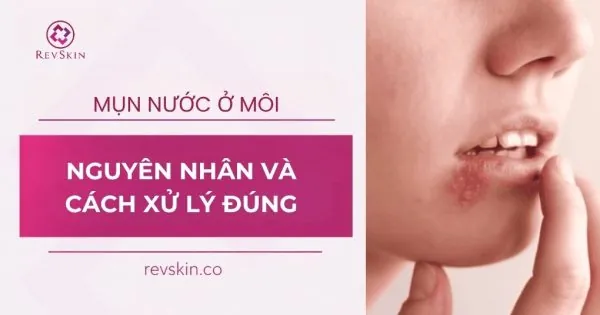 mụn nước ở môi là bệnh gì