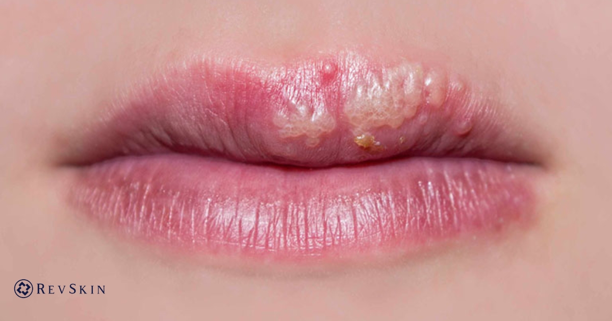 Bị mụn nước ở môi là bệnh gì? Nguyên nhân & cách xử lý đúng Mụn nước ở môi