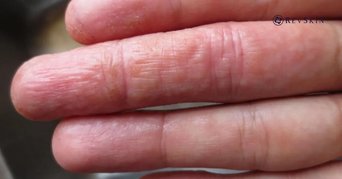 Bị mụn nước ở tay là gì? Nguyên nhân, dấu hiệu và cách xử lý an toàn cho da Mụn nước ở tay