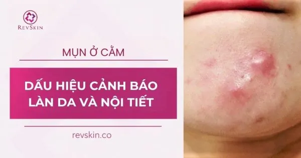 mụn ở cằm dấu hiệu cảnh báo làn da và nội tiết