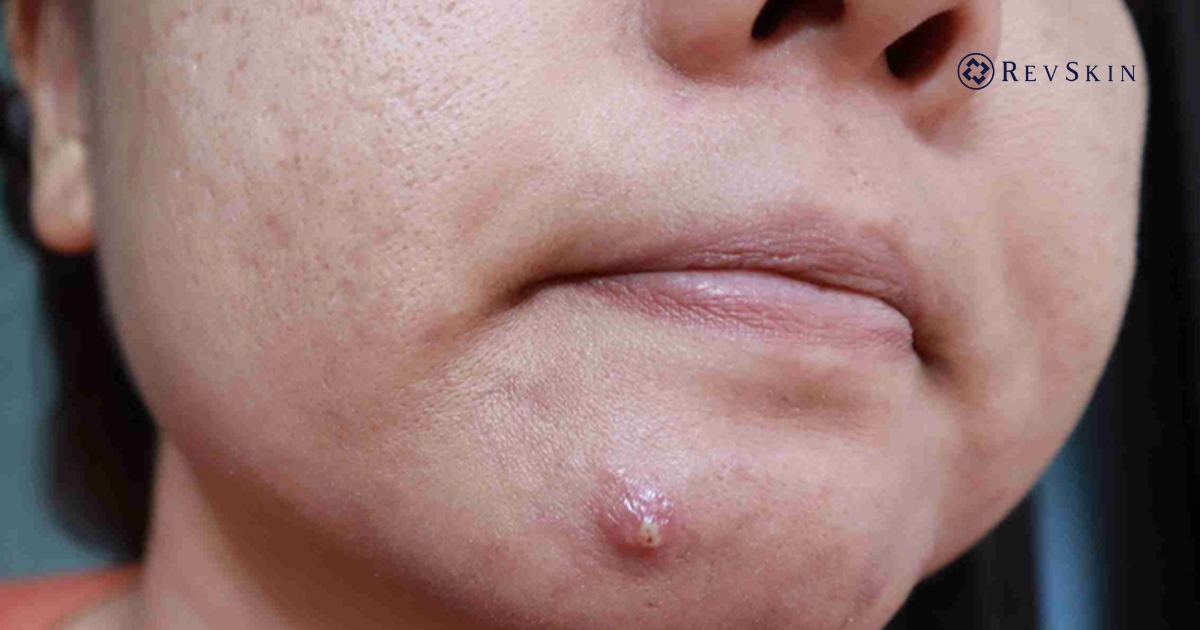 Trị mụn viêm đúng cách: Giải pháp an toàn, hạn chế sẹo Mụn viêm là gì