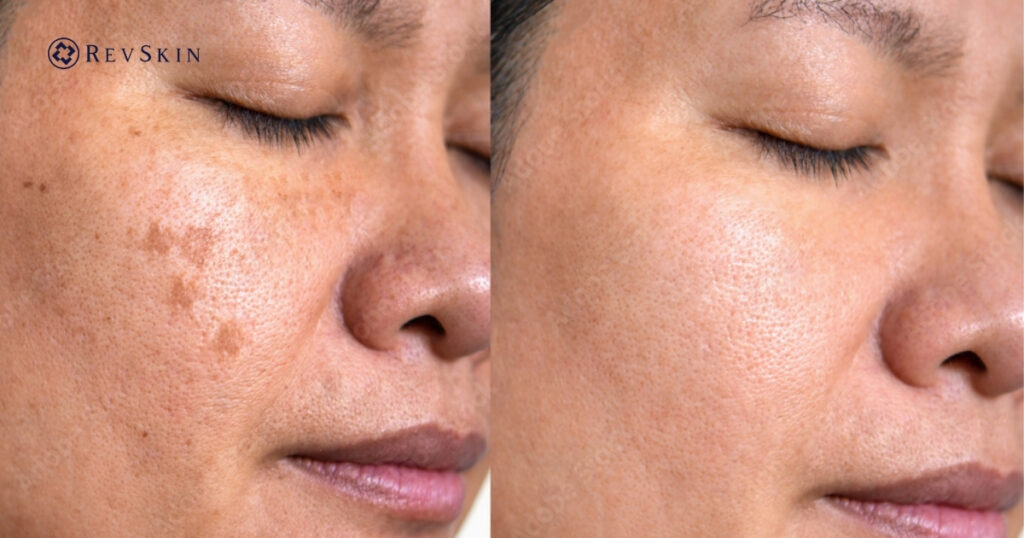 Chuyển giao công nghệ Revskin