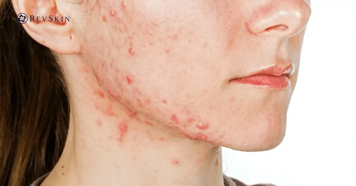 Bị mụn ở cằm là gì? Dấu hiệu cảnh báo làn da & nội tiết bạn không nên bỏ qua Nguyên nhân gây mụn ở cầm