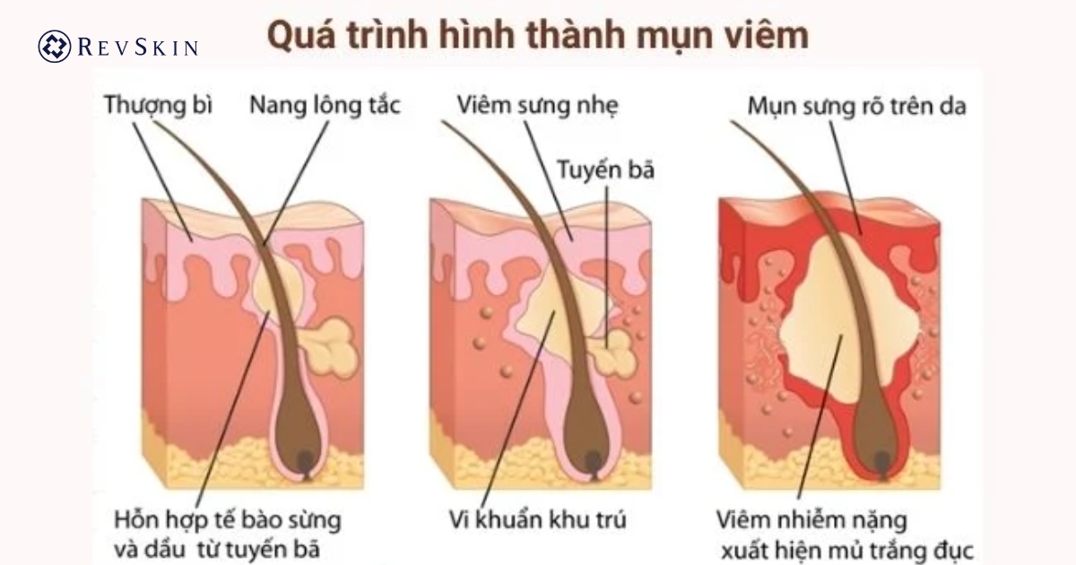 Trị mụn viêm đúng cách: Giải pháp an toàn, hạn chế sẹo Nguyên nhân hình thành mụn viêm
