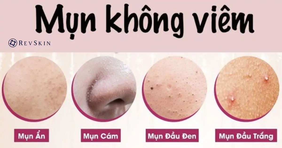 Cách điều trị mụn hiệu quả, an toàn theo chuẩn da liễu Nguyên nhân khiến bị nổi mụn