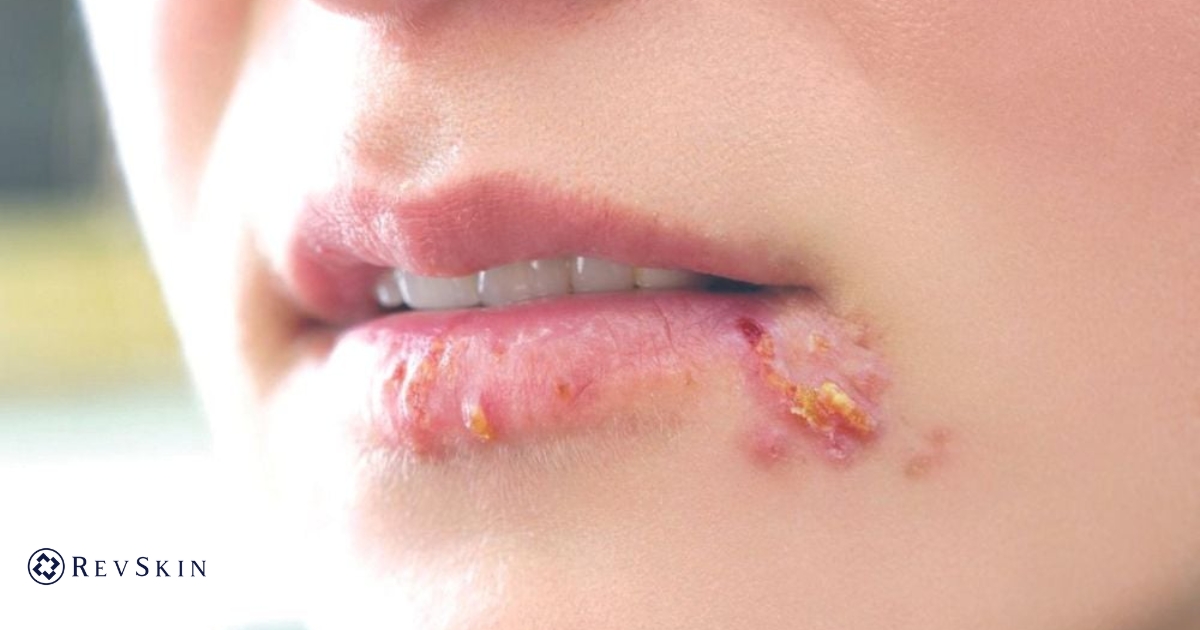 Bị mụn nước ở môi là bệnh gì? Nguyên nhân & cách xử lý đúng Nguyên nhân mụn nước môi