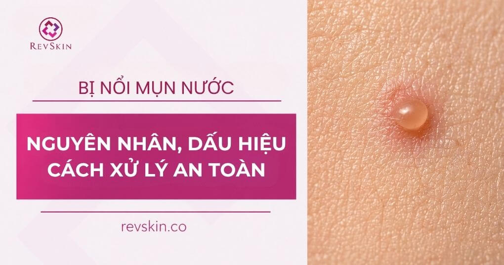Bị nổi mụn nước là gì? Nguyên nhân, dấu hiệu và cách xử lý an toàn nổi mụn nước nguyên nhân và cách xử lý
