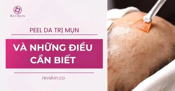 peel da trị mụn và những điều cần biết