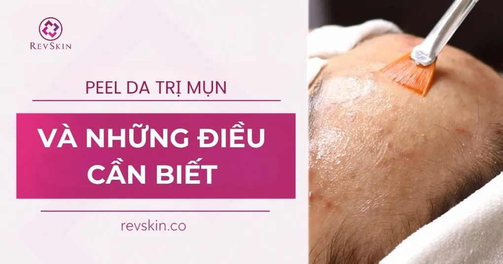 peel da trị mụn và những điều cần biết