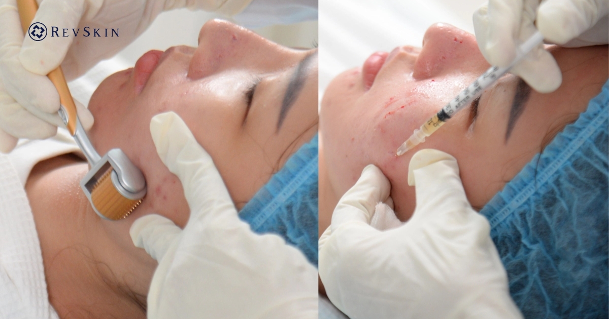 Phác đồ kết hợp PRP với Microneedling