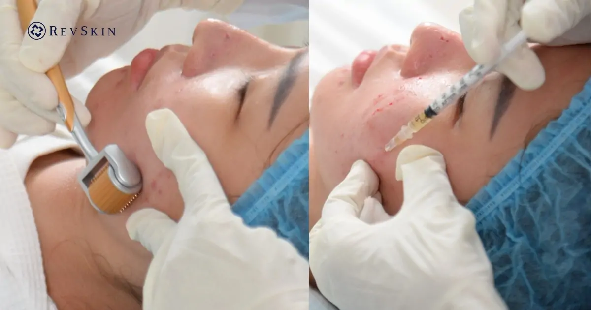 Phác đồ kết hợp PRP với Microneedling