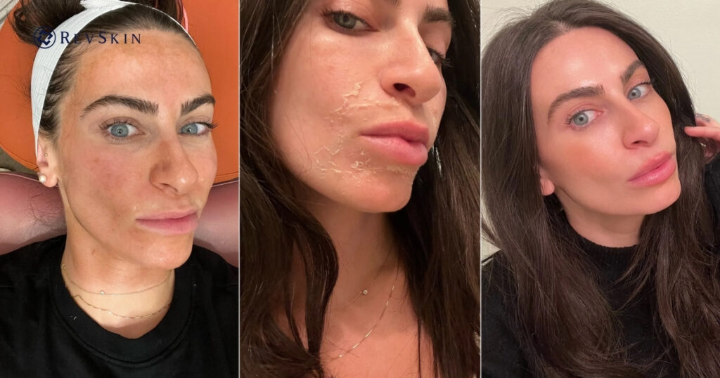 Chuyển giao công nghệ Revskin
