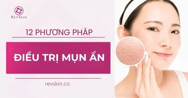 phương pháp điều trị mụn ẩn an toàn hiệu quả