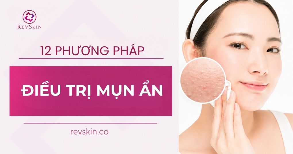 12 phương pháp điều trị mụn ẩn dưới da an toàn, hiệu quả phương pháp điều trị mụn ẩn an toàn hiệu quả