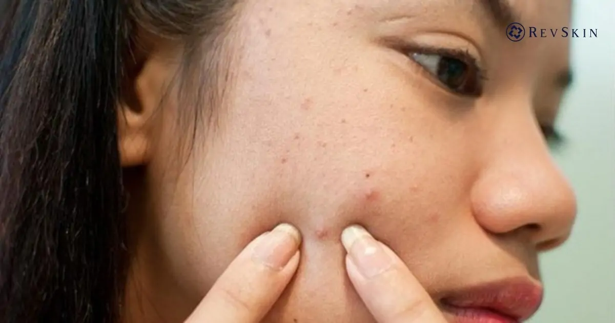 Cách điều trị mụn hiệu quả, an toàn theo chuẩn da liễu Sai lầm phổ biến khi điều trị mụn