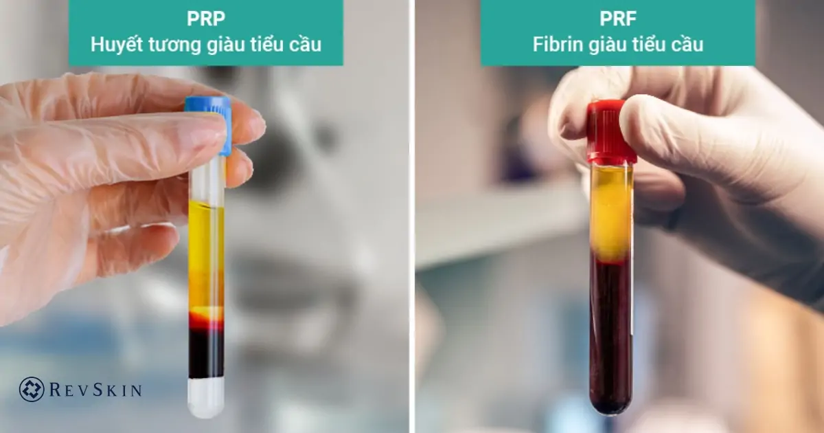 So sánh tiêm PRP và PRF