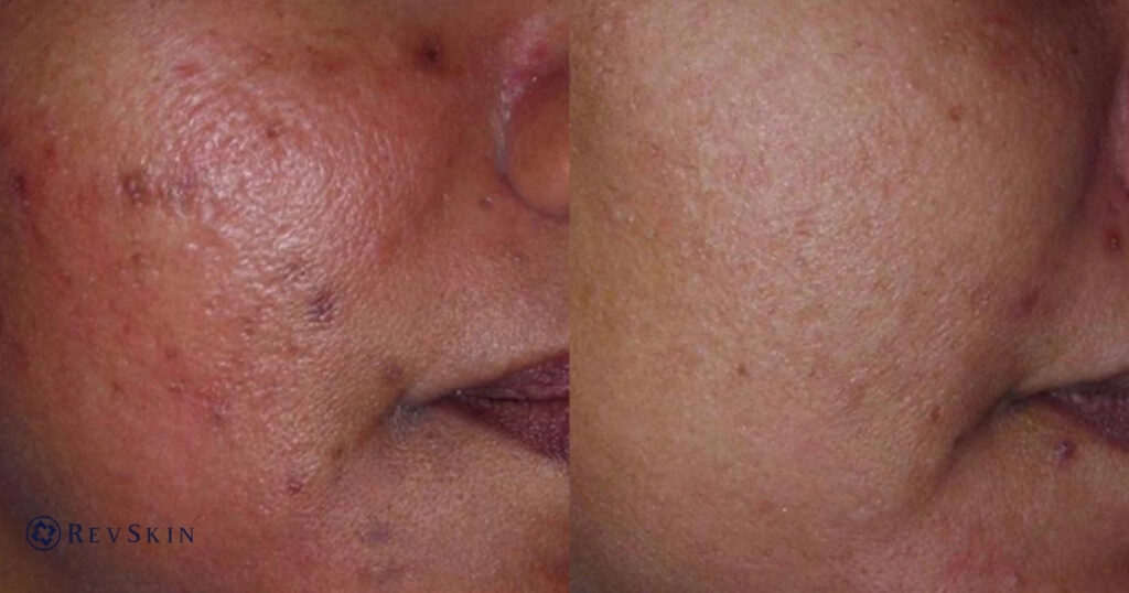 Chuyển giao công nghệ Revskin