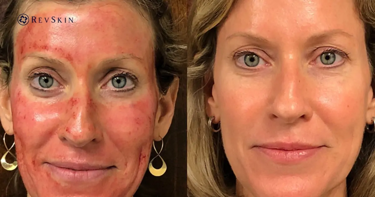 Ứng dụng PRP trong thẩm mỹ