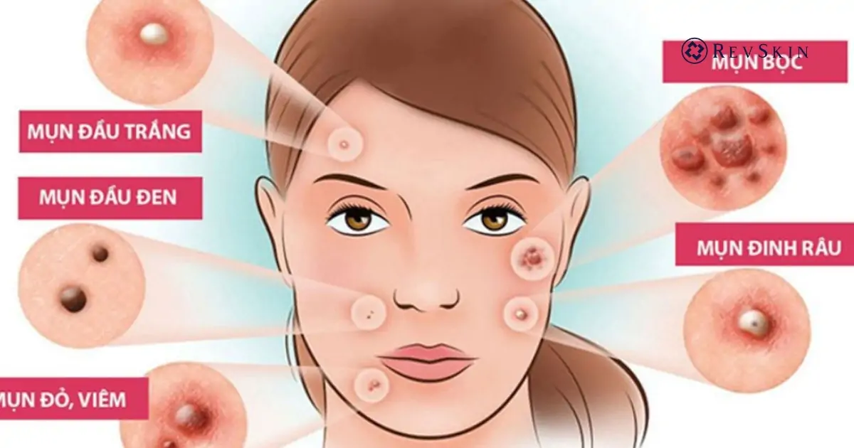 Cách điều trị mụn hiệu quả, an toàn theo chuẩn da liễu Vì sao cần điều trị mụn đúng cách