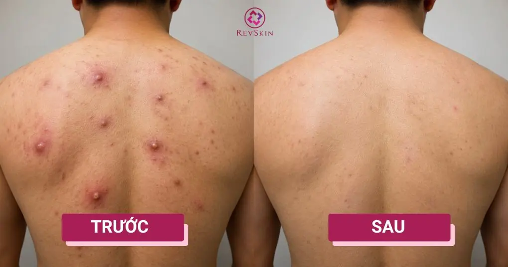 Mụn nhọt ở lưng là gì? Nguyên nhân, chẩn đoán và cách điều trị before after mụn nhọt lưng mức độ trung bình