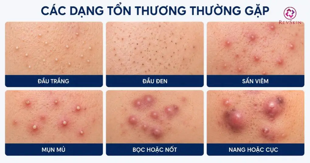các dạng tổn thương mụn trứng cá
