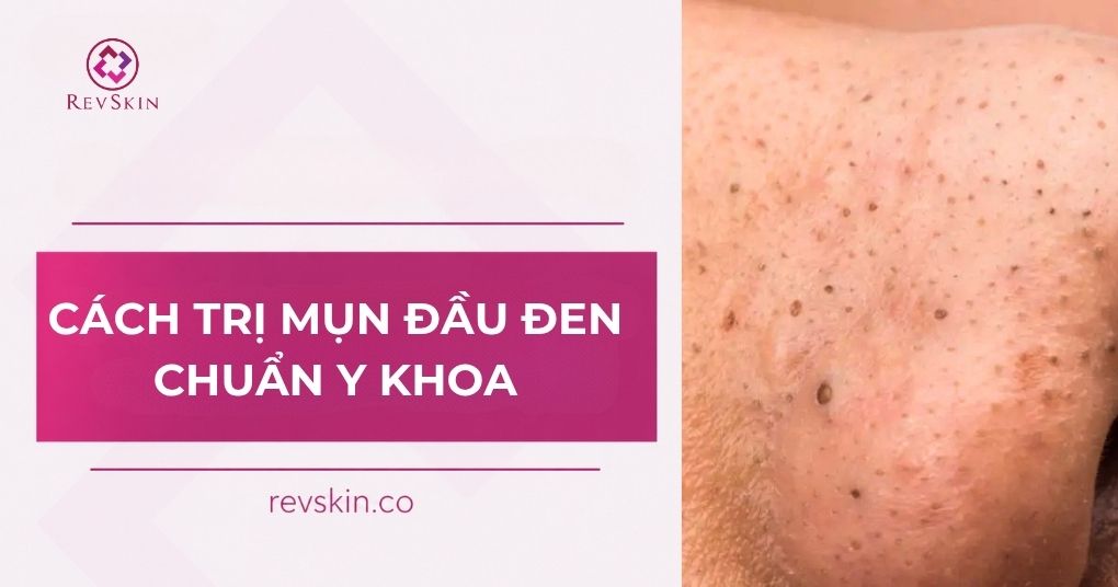 cách trị mụn đầu đen chuẩn y khoa