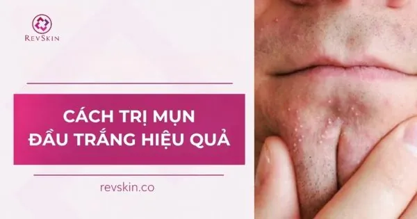 cách trị mụn đầu trắng hiệu quả