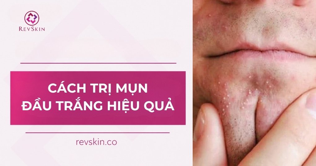 cách trị mụn đầu trắng hiệu quả