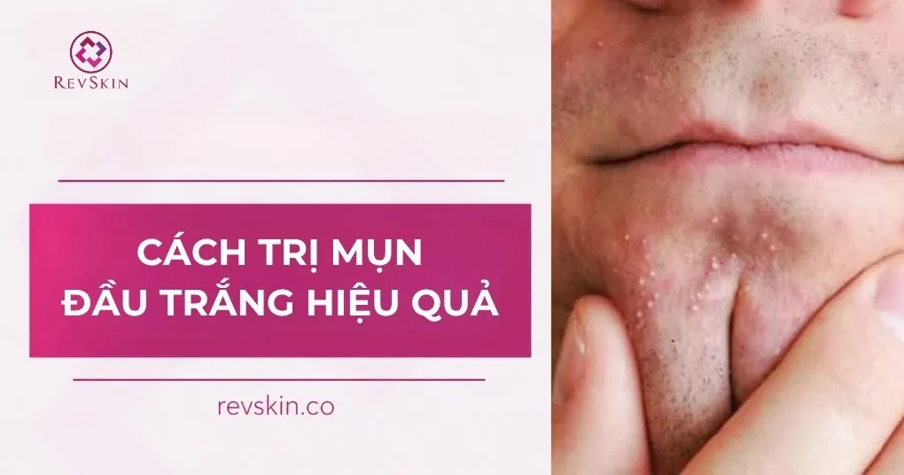 Cách trị mụn đầu trắng hiệu quả theo phác đồ y khoa cách trị mụn đầu trắng hiệu quả