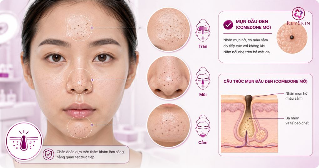 Mụn đầu đen: Nguyên nhân, vị trí thường gặp và cách điều trị chẩn đoán lâm sàng mụn đầu đen