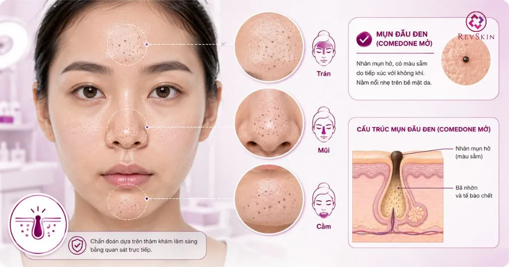 chẩn đoán lâm sàng mụn đầu đen