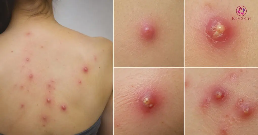Mụn nhọt ở lưng là gì? Nguyên nhân, chẩn đoán và cách điều trị chẩn đoán mụn nhọt vùng lưng