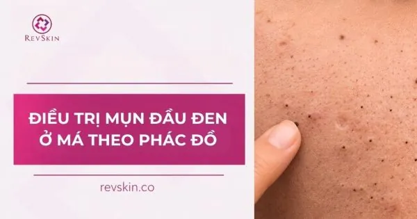 điều trị mụn đầu đen ở má theo phác đồ