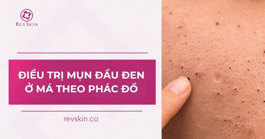 điều trị mụn đầu đen ở má theo phác đồ