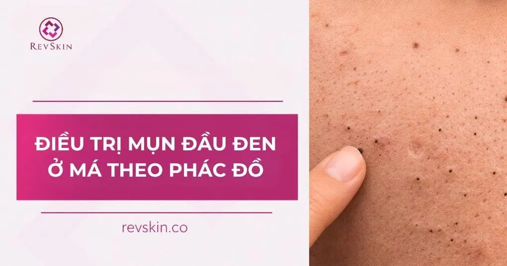 điều trị mụn đầu đen ở má theo phác đồ