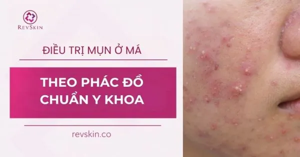 điều trị mụn ở má theo phác đồ chuẩn y khoa