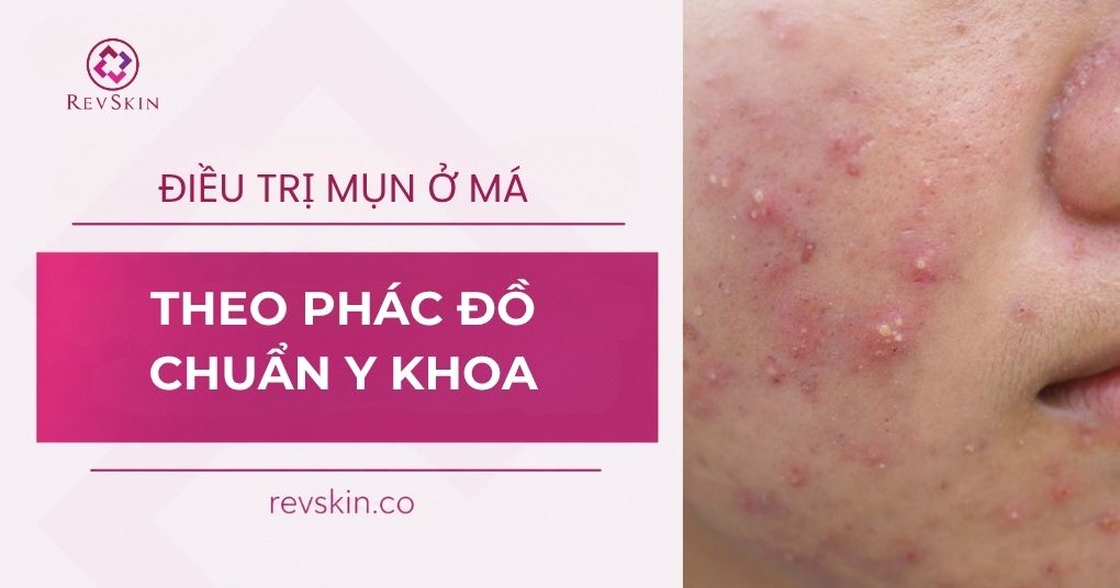 điều trị mụn ở má theo phác đồ chuẩn y khoa