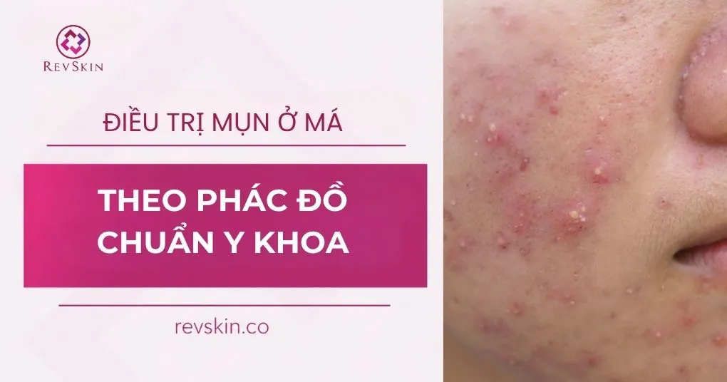điều trị mụn ở má theo phác đồ chuẩn y khoa