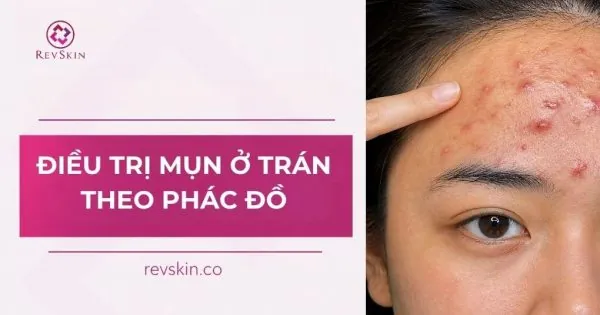 điều trị mụn ở trán theo phác đồ