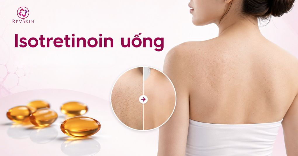 Mụn ẩn ở lưng: Nguyên nhân và cách điều trị chuẩn y khoa isotretinoin uống trị mụn ẩn ở lưng