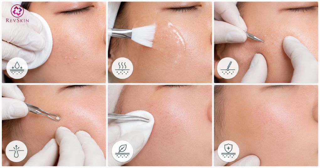 lấy nhân mụn đầu trắng y khoa
