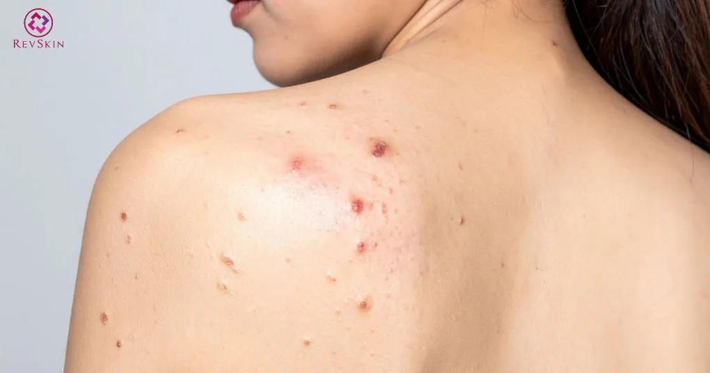 ma sát mồ hôi gây mụn lưng