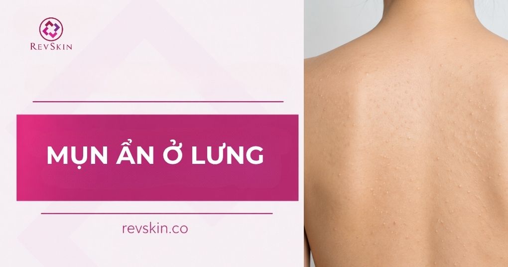 Mụn ẩn ở lưng: Nguyên nhân và cách điều trị chuẩn y khoa mụn ẩn ở lưng