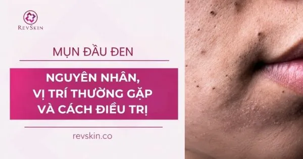 mụn đầu đen là gì